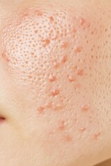 Fototapeta premium A closeup of problematic skin with visible acne and redness before treatment, set against a neutral background, ideal for skincare tutorials and product use.