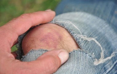 torn jeans and bruise on knee from injury close up. hematoma on knee from injury. selective focus