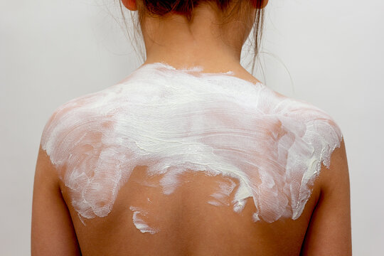Rear view of child back with sun cream on shoulders as sun protection concept