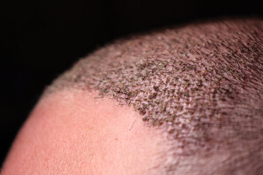 close-up of a head of a man with a recent hair implant on a black background

