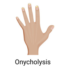 Nail Onycholysis vector illustration design.