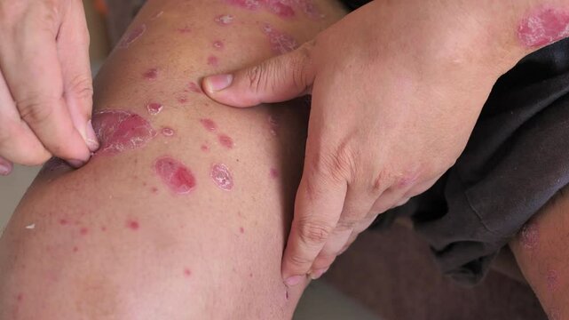 The people scratching skin Psoriasis. Psoriasis skin rash flare-up 
