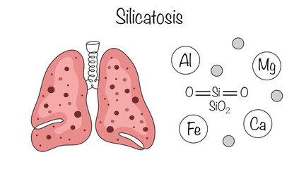 Silicatosis