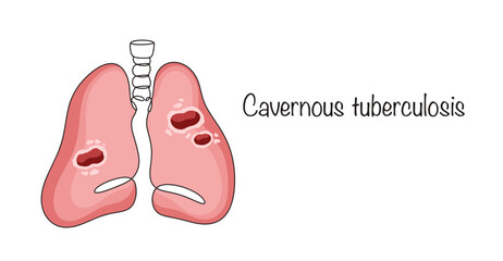 Cavernous tuberculosis