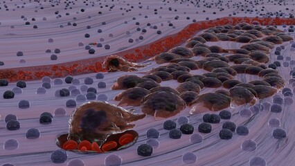 Adenocarcinoma with våssel invasion, 3d illustration