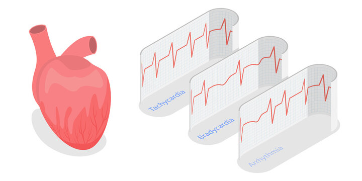 3D Isometric Flat  Illustration of Pathological Heart Rhythm Types, Electro-cardiogram
