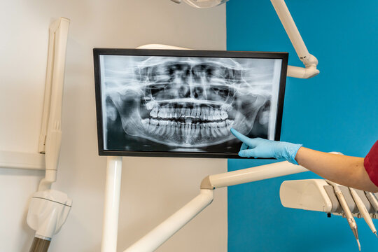 Mano de dentista se&ntilde;alando el tac de la boca de un paciente, en una cl&iacute;nica dental.