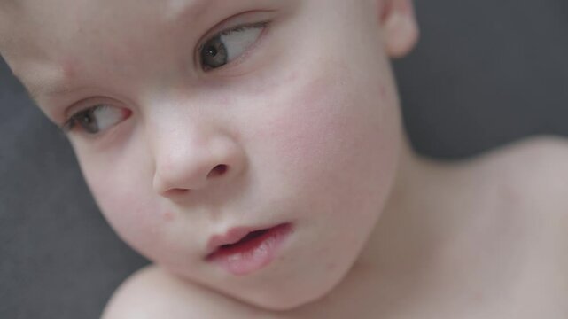 Child with battling chickenpox close-up red spots on sad face. Sad face with red spots of illness boy Valiant effort to remain cheerful eyes betray deep sorrow discomfort Sad face of boy