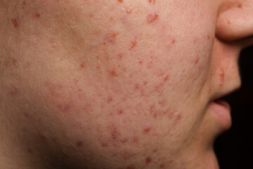 Close-up of the skin with pimple problems. Pimples, acne, pores, scars. Natural skin. Skin texture...