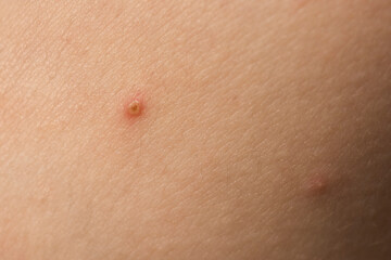 Fototapeta premium Treatment for skin. Problem skincare. Pimple closeup. Skin texture. Closeup acne skin. Treatment for skin. Problem skincare. Acne treatment.