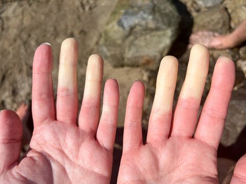 Woman with Raynaud's Syndrome Shows Affected Hands After Swimming