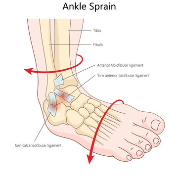 ankle sprain showing torn ligaments, anterior talofibular and calcaneofibular ligaments, injury mechanics diagram hand drawn schematic vector illustration. Medical science educational illustration
