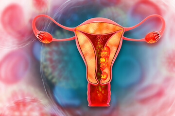 Female reproductive system diseases. Uterus cancer and endometrial malignant tumor as a uterine medical concept. 3d illustration