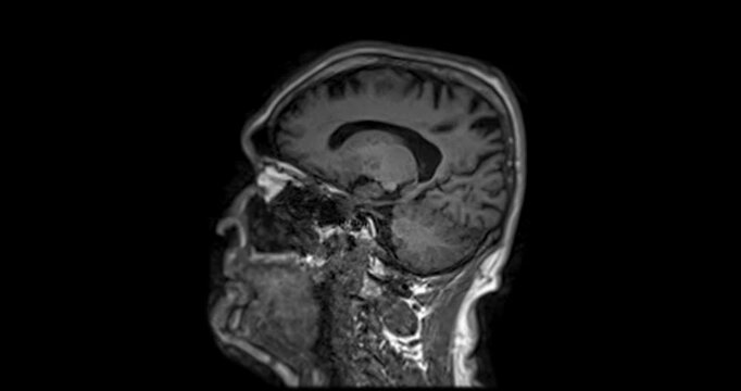 The MRI brain footage reveals areas of reduced blood flow, indicating early signs of stroke disease.