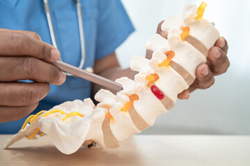 Doctor with lumbar vertebra bone skeleton and nerve model for treatment in the orthopedic department.