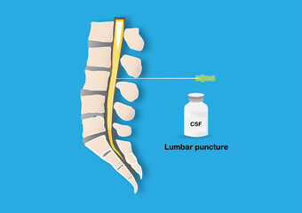 Lumbar puncture procedure illustration