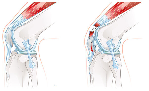 Quadriceps tendon rupture. Knee injury. Sports injury. Knee pain. Front view. Labeled medically illustration