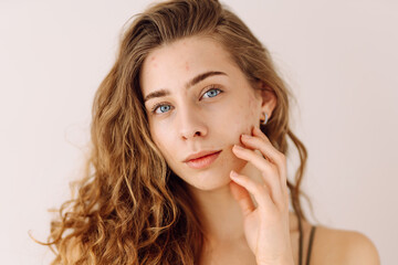 Young woman with acne and rashes on her face. Dermatology, cosmetology, skin care. Natural skin.