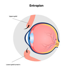 Entropion eye ophthalmology problem diagram