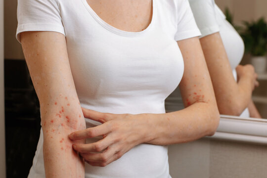 Itching and scabies in skin diseases that worsen the quality of human life. The girl combs the skin on her hand. Dermatitis, allergy, eczema, psoriasis concept.
