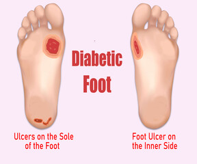 Diabetic Foot Ulcers on inner and Sole Sides 3D Illustration