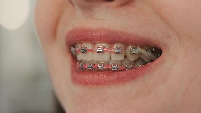 Teenager with braces on teeth. Happy girl smiling and showing dental rubber bands. Health care and medical concept. Close-up.