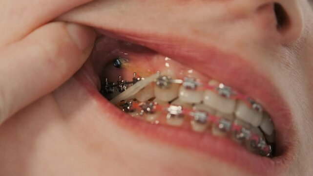 Teenager with braces on teeth. Happy girl smiling and showing dental mini screws. Health care and medical concept. Close-up.