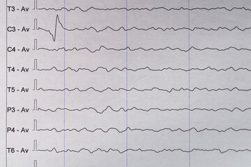 Electroencephalography data on paper. Encephalogram results. Brain activity waves