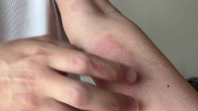 Young asian man itching and scratching on arm from allergic itchy dry skin eczema dermatitis insect bites