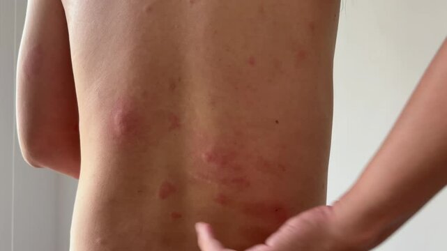 Young asian man itching and scratching on his back from allergic itchy dry skin eczema dermatitis insect bites