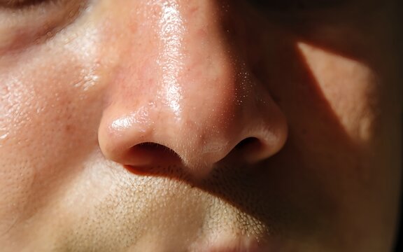 oily face skin condition closeup. Sebum gland production