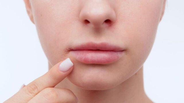 Woman showing herpes disease on her lips. Treatment of viral infections.