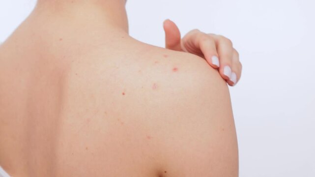 Young girl shows pimples on her skin on her back and shoulders.