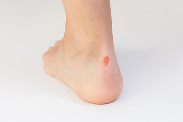 A close-up photo of a corn on a woman's foot, formed on the heel due to uncomfortable shoes.