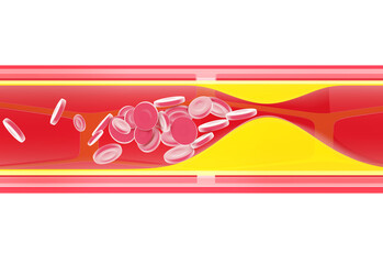 Anatomical 3D illustration of the interior of an artery showing the layers that form it. Obstructed by the accumulation of fat. Red blood cells form a plug and prevent blood circulation.