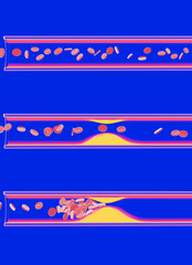 3D illustration of the interior of a transparent glass artery. Obstructed by the accumulation of fat (cholesterol). Movement of red blood cells and platelets in an interrupted blood circulation.