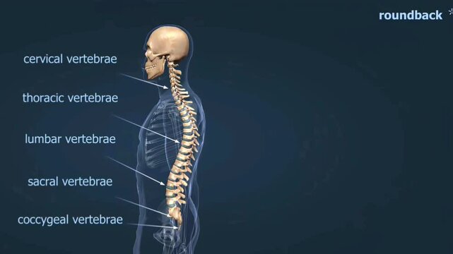 Roundback condition of the spine