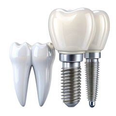 Isolated set of white teeth and dental implant on transparent background