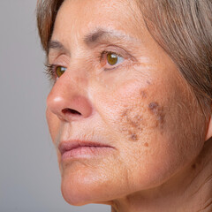 Obraz premium Woman Suffering From Actinic Keratosis