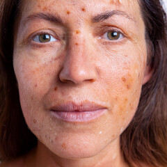 Fototapeta premium Woman Suffering From Actinic Keratosis