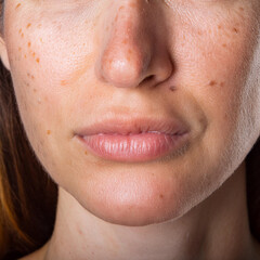 Fototapeta premium Woman Suffering From Actinic Keratosis