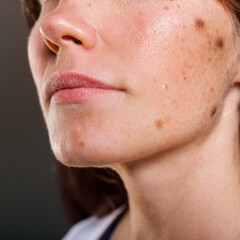 Fototapeta premium Woman Suffering From Actinic Keratosis