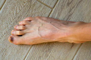 Runner's Feet: Black Toenails from Athletic Trauma. Barefoot Athlete's Feet Displaying Common Sports Injury