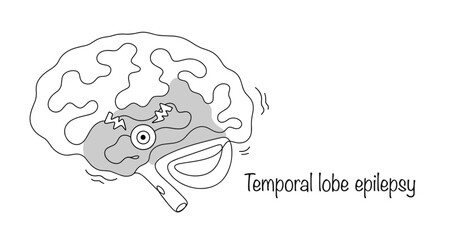 Temporal lobe epilepsy