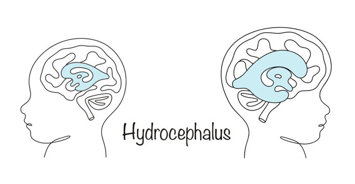 Hydrocephalus