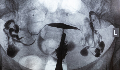 X-ray image of Hysterosalpingography (HSG). MRI with contrast agent. Patency of the uterus, ovaries...