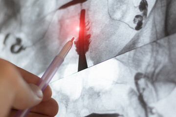 Doctor examining X-ray image of Hysterosalpingography (HSG). MRI with contrast agent. Uterine...