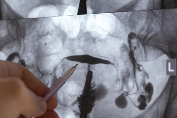 Doctor examining X-ray image of Hysterosalpingography (HSG). MRI with contrast agent. Uterine tubes, analysing female reproductive system. Infertility treatment.