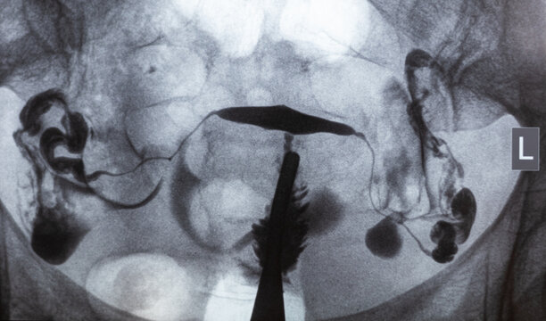 X-ray image of Hysterosalpingography (HSG). MRI with contrast agent. Patency of the uterus, ovaries and fallopian tubes. Uterine tubes, analysing female reproductive system. Infertility treatment.