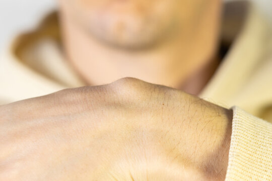 Hygroma of the man's wrist. Ganglion cyst on hand. Close up.